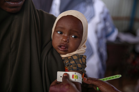 A Child Being Checked For Malnourishment At A Clinic In Somalia. Photo Miriam Donoghue, Trocaire, Caritas Ireland